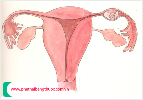 Cần thăm khám và điều trị kịp thời tình trạng mang thai ngoài tử cung