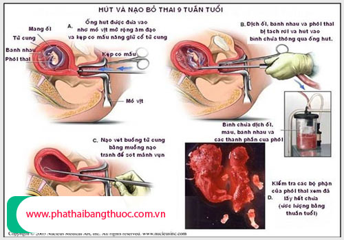 Hút thai an toàn bảo vệ sức khỏe sinh sản